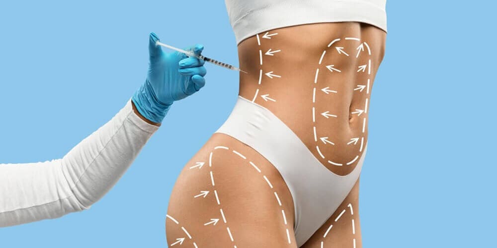 Liposuction
